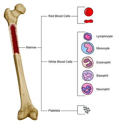 leukemia bone marrow. Haematologic syndromes result