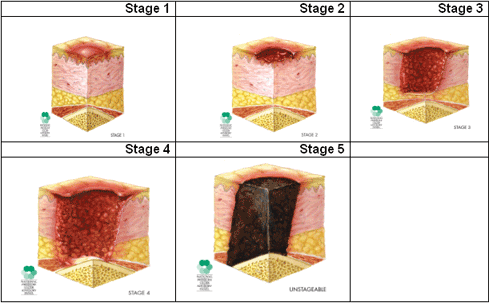 Pressure Ulcer Stages