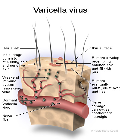 Topic ebola virus disease,